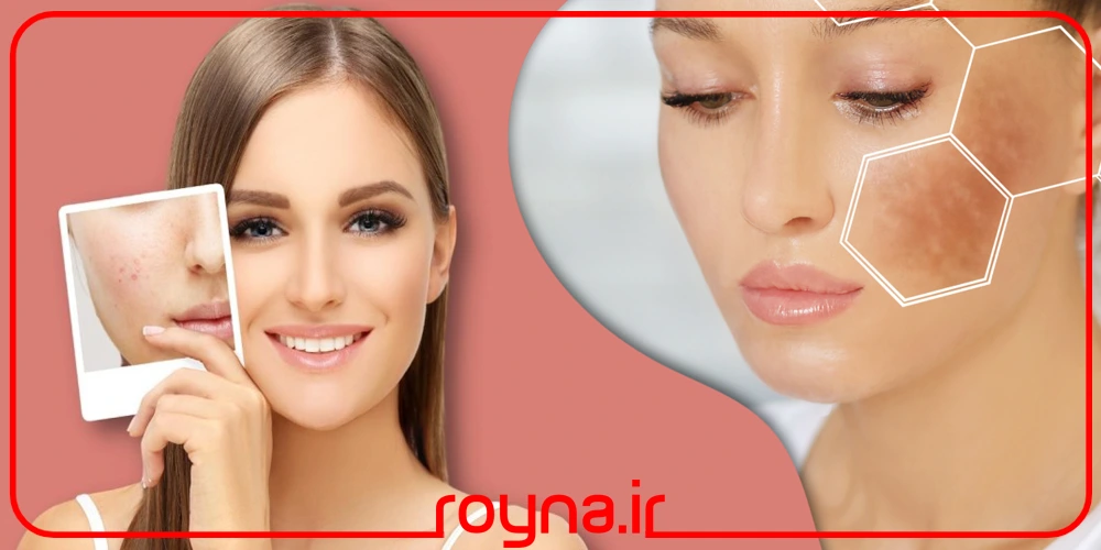 کمبود چه ویتامینی باعث تیرگی پوست می شود؟ برای سفید شدن چه ویتامینی بخوریم؟
