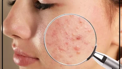 مراحل پاکسازی پوست چرب و جوش دار در سریعترین زمان