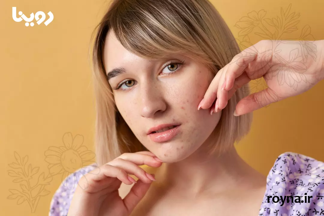 از بین بردن جوش برای همیشه؛ ترفندهای علمی و خانگی!