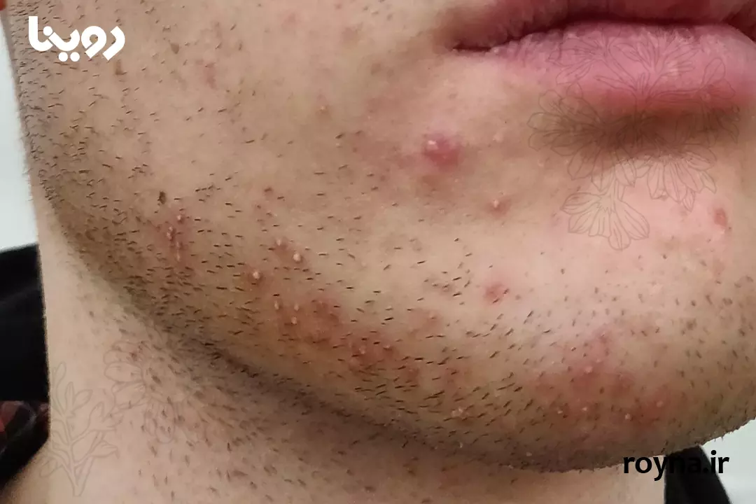 چرا بعد از اصلاح صورت جوش میزنیم؟ + 10 دلیل مهم و کلیدی 1