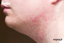 چرا بعد از اصلاح صورت جوش میزنیم؟ + 10 دلیل مهم و کلیدی