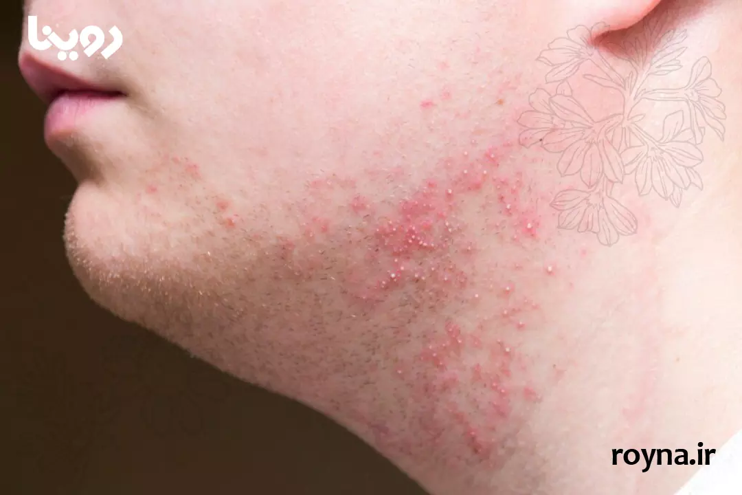 چرا بعد از اصلاح صورت جوش میزنیم؟ + 10 دلیل مهم و کلیدی