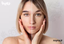 0 تا 100 جوش صورت - انواع، علت، درمان و از بین بردن جای جوش