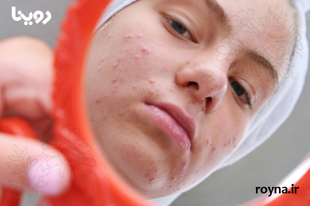 ترفند نابود کردن جوش صورت در کمتر از 1 ساعت 100% تصمینی