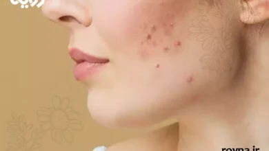 جوش هورمونی در چانه و فک و روش‌های درمان آن