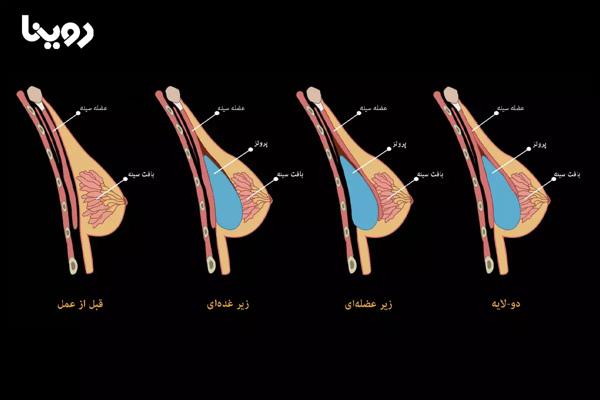 نمونه جراحی سینه بدون وکیوم سینه بانوان