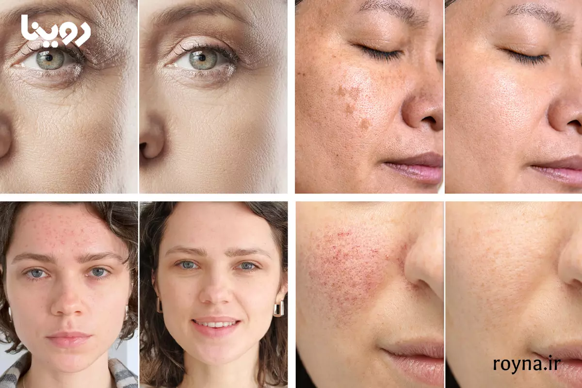 تصویر قبل و بعد از میکرودرم کردن پوست