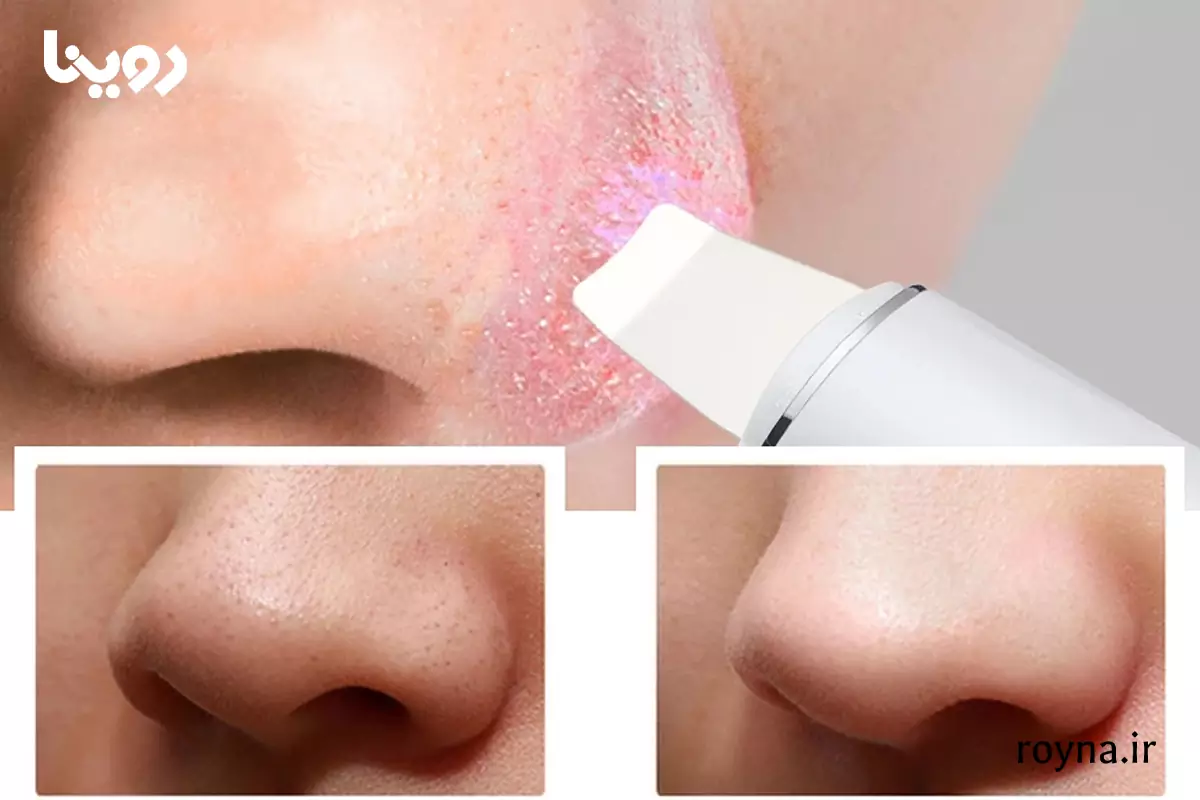 قرمزی پوست پس از استفاده از اتو صورت