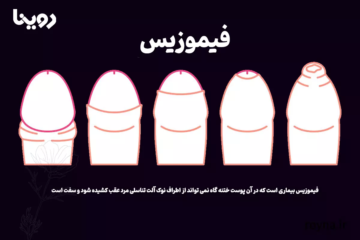 آلت تناسلی مردانه و هر آنچه که باید بدانید! 3 فیموزیس آلت تناسلی مرد و مشکل ناحیه ختنه گاهی